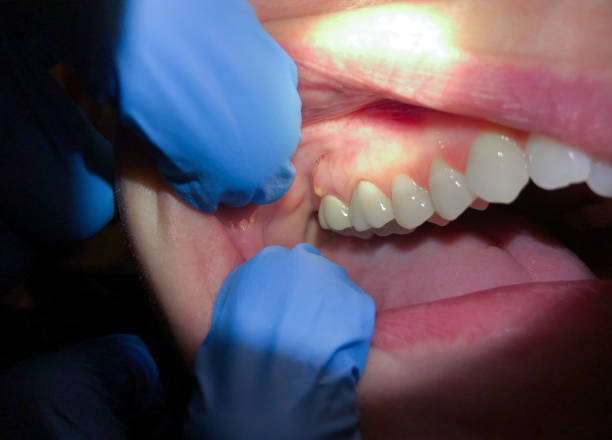 Best Emergency Wisdom Teeth Removal in Centerville, PA